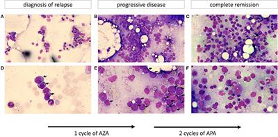 Successful Treatment of Early Relapsed High-Risk AML After Allogeneic Hematopoietic Stem Cell Transplantation With Biomodulatory Therapy